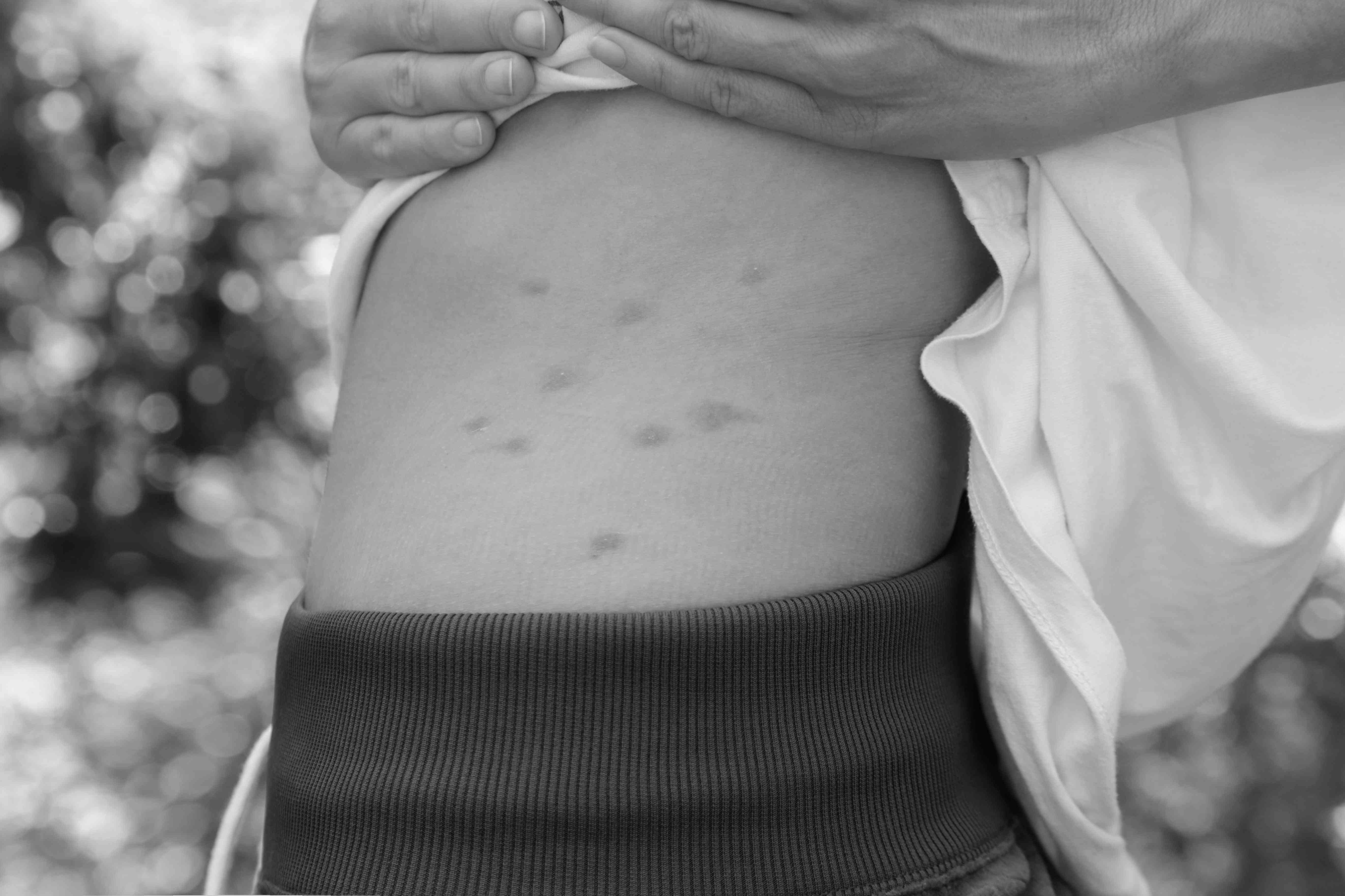 Best Insect Bite Treatments